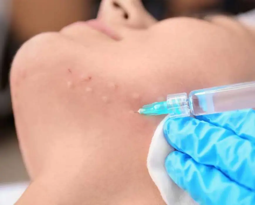 Mesotherapy vs. Hair Transplant: Which Is Better?