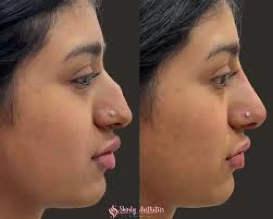 Nonsurgical Rhinoplasty in Islamabad: The Safer Alternative to Nose Surgery