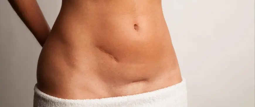 Scar Removal in Dubai for Acne Scars: What Actually Works
