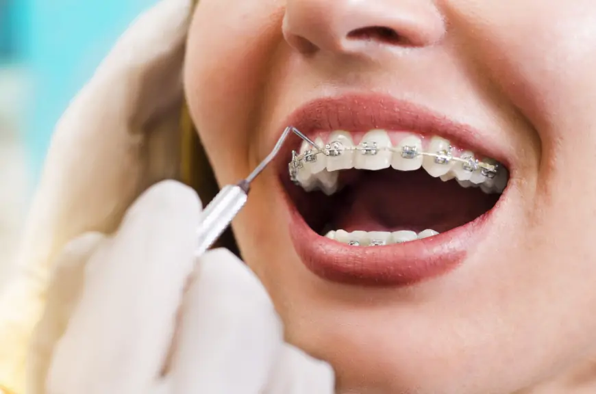 Braces and Dating: Navigating Relationships with Metal Braces