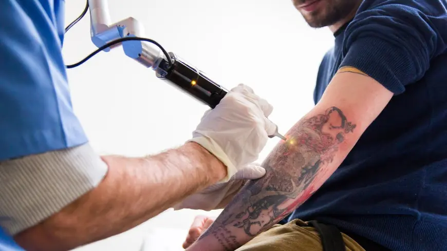 Can Tattoo Removal Cause Scarring? How to Minimize Risks