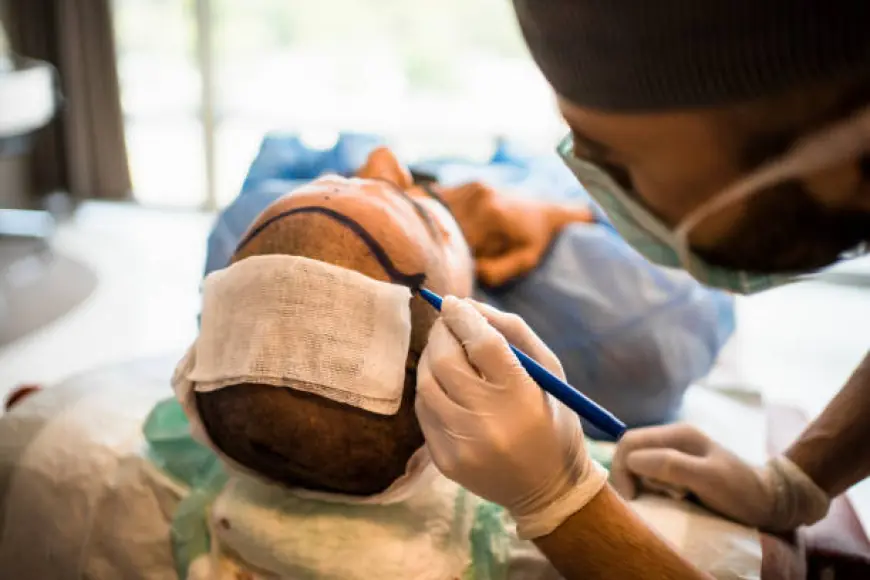 لماذا يختار الرجال زراعة الشعر