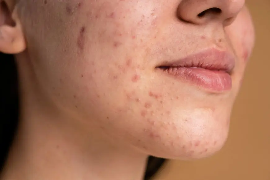 Can Retinol Fade Pigmentation Safely?