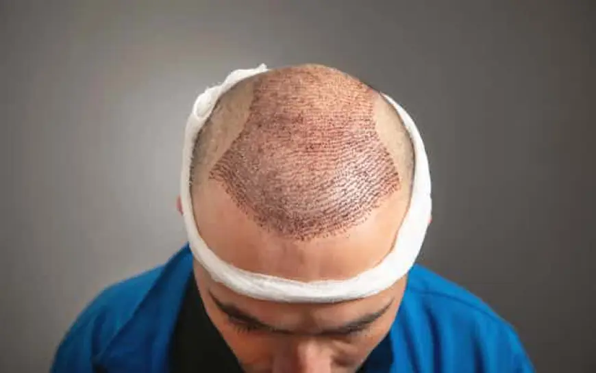 Can Body Hair Be Used for Hair Transplantation?