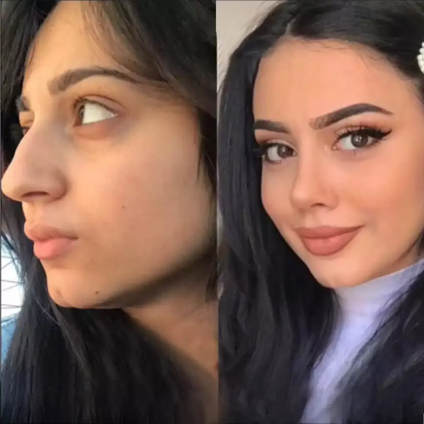 Everything You Need to Know About Rhinoplasty Dubai Procedures