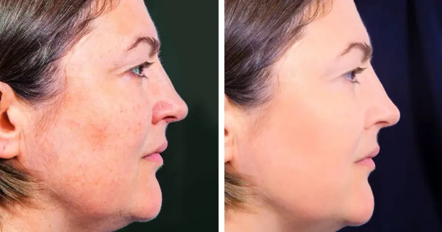 Is Profhilo in Dubai Safe for Sensitive Skin