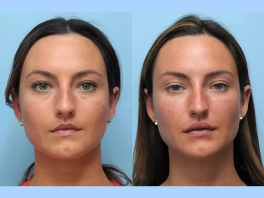 Confidence Boost from the Best Doctors in Dubai for Thread Lift