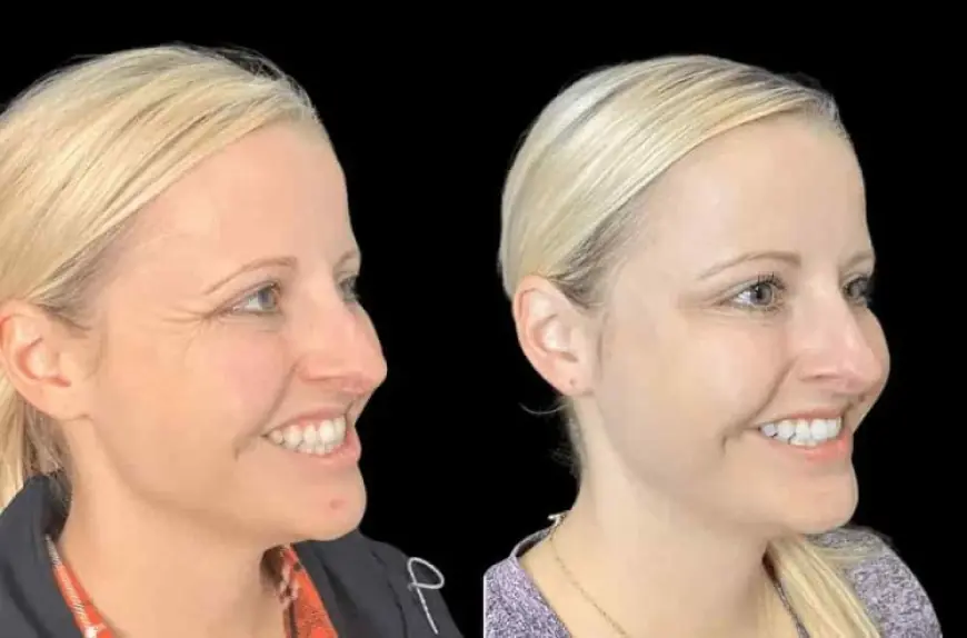 Botox in Dubai: Beauty Treatments That Actually Work