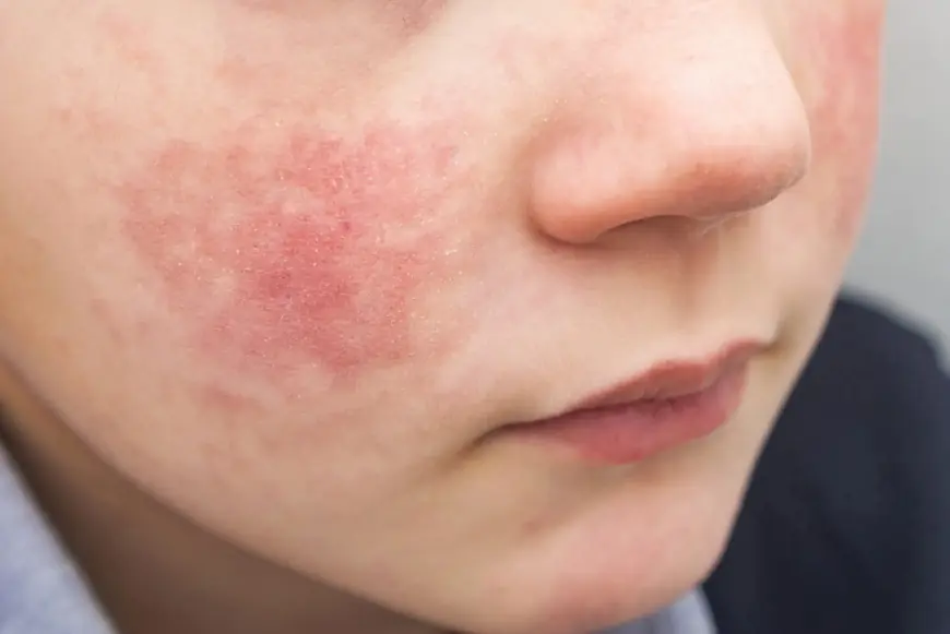 Can a dermatologist treat scalp eczema in kids