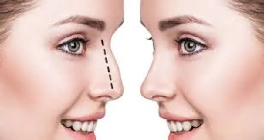 Rhinoplasty in Dubai: What to Expect Before, During, and After the Procedure