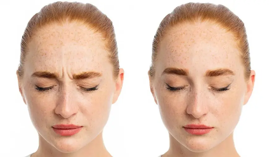 Botox Bekymringsrynke
