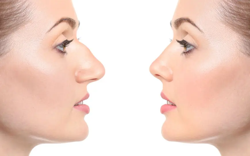 Glow from Every Angle with Rhinoplasty Price in Dubai