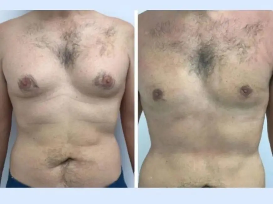 Redefine Your Physique with the Best Gynecomastia Surgeon in Dubai