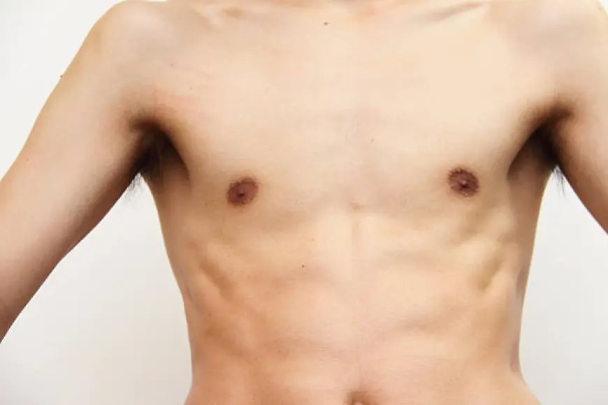 Exercises vs. Gynecomastia Surgery – What Works?