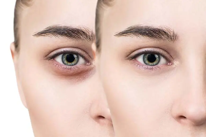 Laser vs Topical Creams: What Works for Dark Circles?