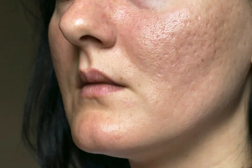 Affordable Acne Scar Treatment Options in Islamabad