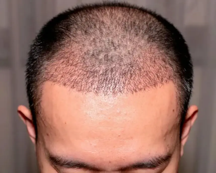 Choosing the Best Hair Transplant Surgeon in Islamabad: Everything You Need to Know