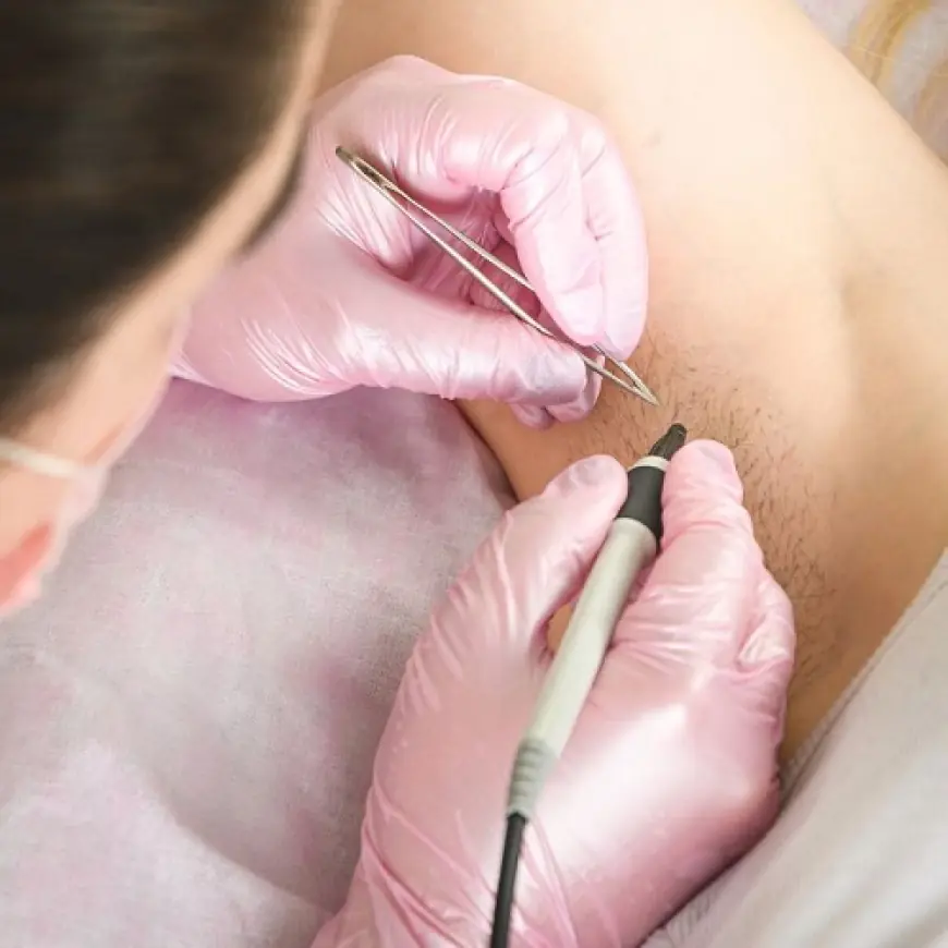 Is Electrolysis better than regular laser hair removal?