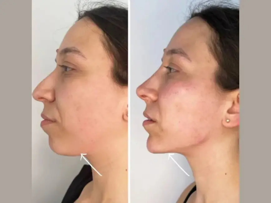 Discover the Secret to Youthful Elegance with Endolift Treatments in Dubai
