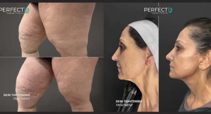 Non-Surgical Treatment for Sagging Skin Around the Face and Body in Doral, FL