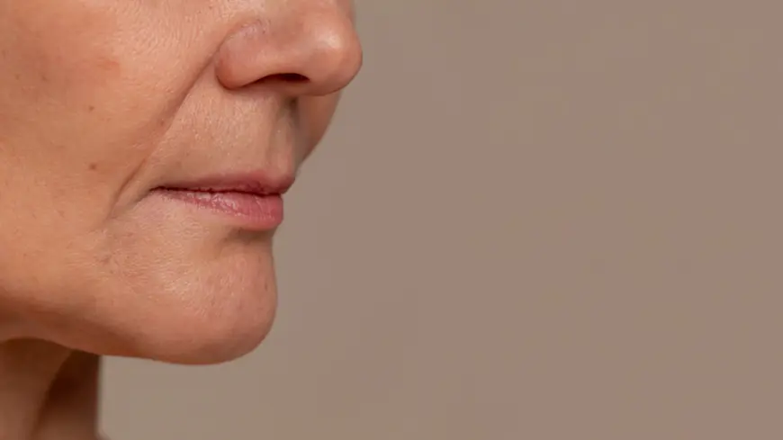 Is Sculptra Effective in Treating Marionette Lines?