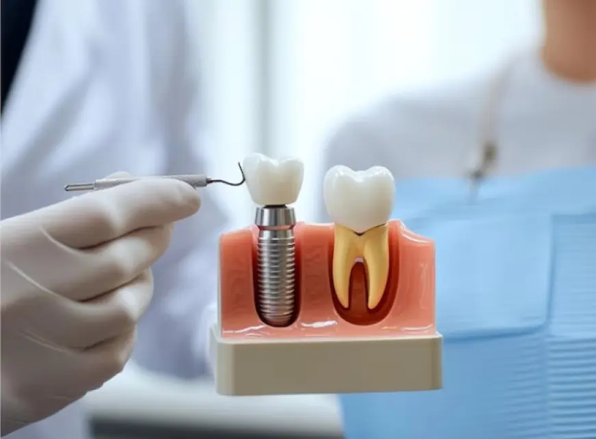 Full Mouth Dental Implants: Are They Right for You?