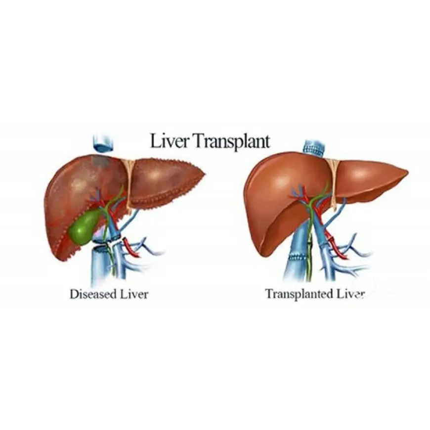 How Much Does a Liver Transplant Cost in Singapore?