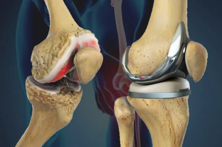 Tips for Managing Pain After Knee Replacement Surgery