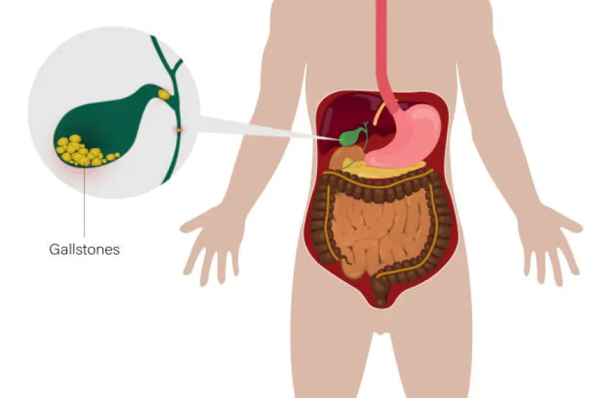 Gallstones Singapore: Early Diagnosis and Prevention Tips