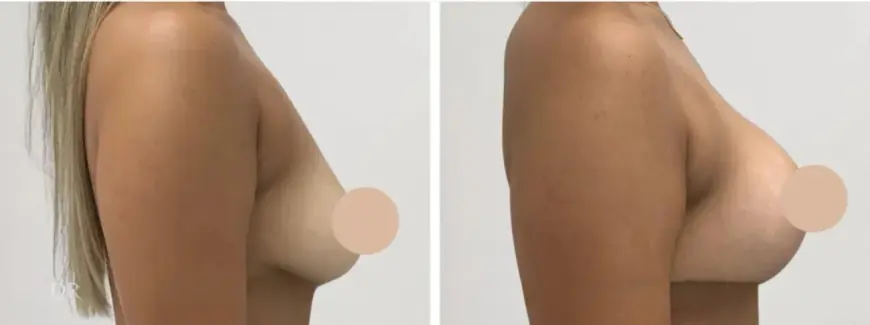 Customizing Your Breast Lift in Dubai