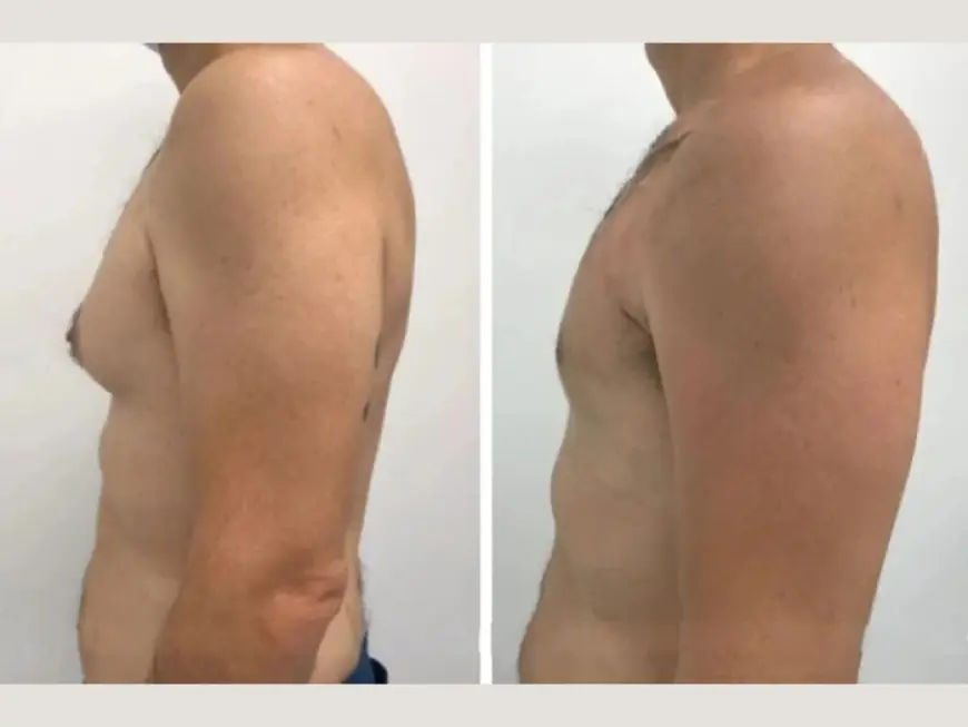 Looking Your Best with Gynecomastia in Dubai