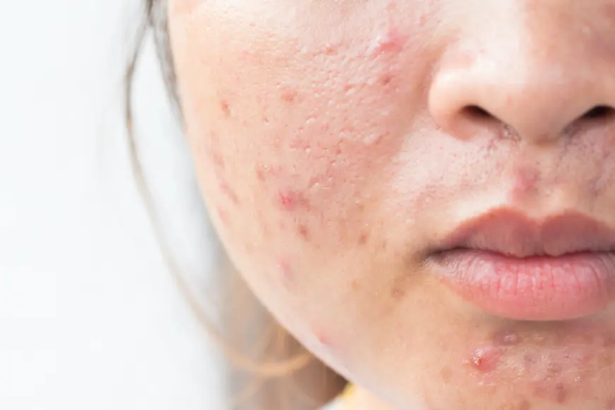 Is Pigmentation Treatment Safe for All Skin Types?