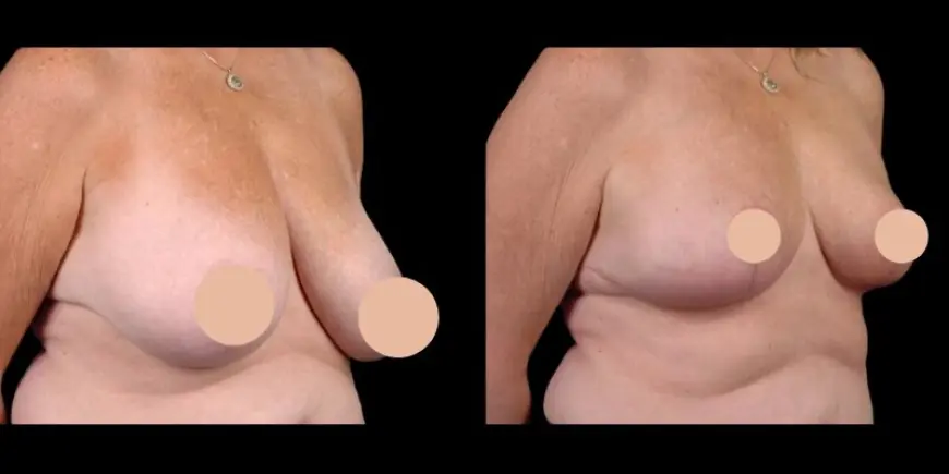 Average Vs. Elite Clinic Costs for Breast Reduction in Dubai
