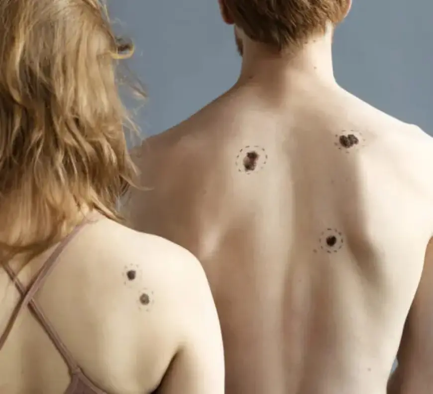 Birthmark Removal in Dubai: Understanding the Recovery Timeline