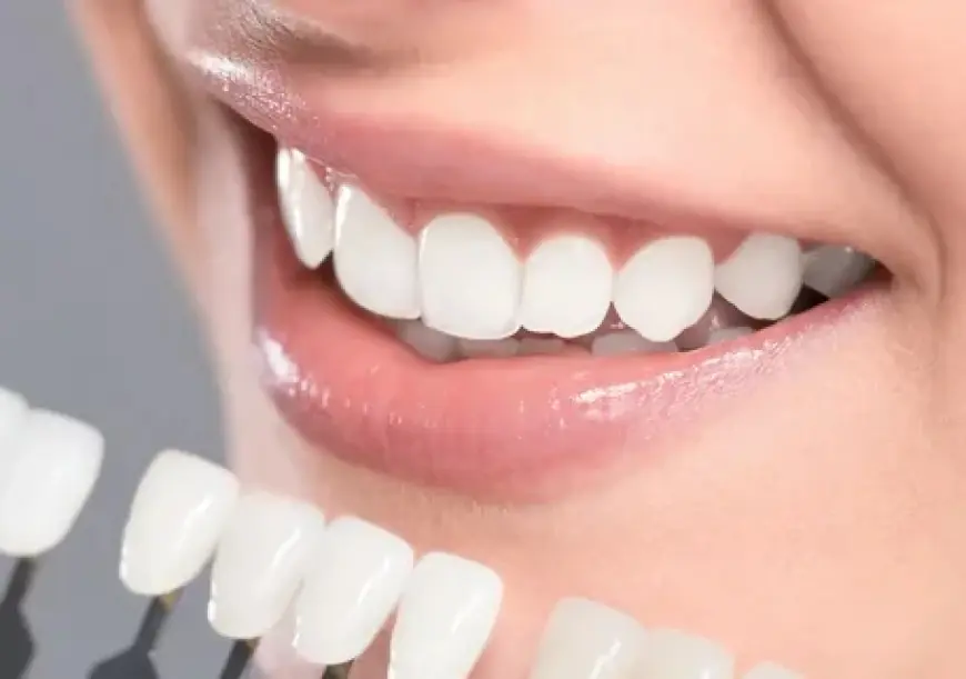The Complete Guide to Veneers Fayetteville NC for a Stunning Smile