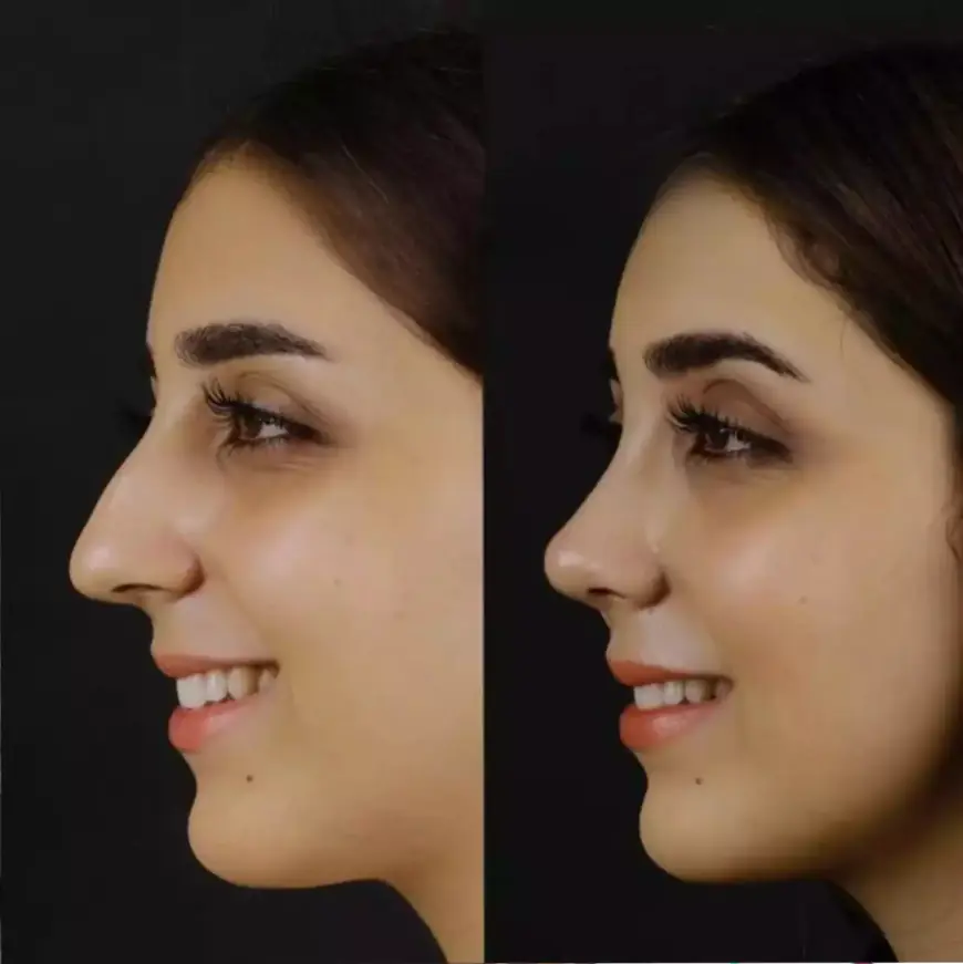 How to Identify the Best Septoplasty Surgeon in Dubai