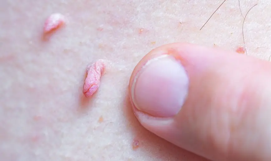 How to Remove Skin Tags on the Inner Thigh Tips From Dermatologists