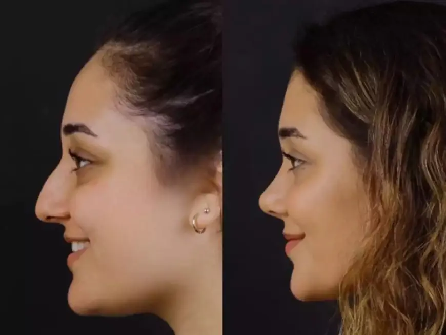 Best Rhinoplasty Surgeon in Dubai: Key Skills to Look For