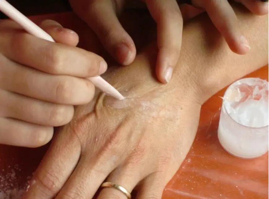 Can Natural Oils Speed Up Vitiligo Recovery? Here’s What Experts Say