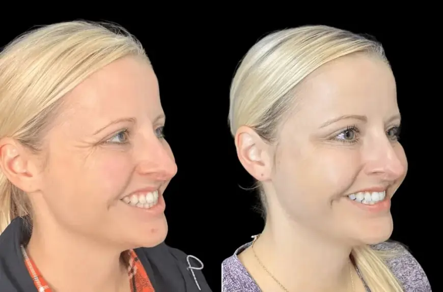 Is Preventative Botox in Dubai the Secret to Youthful Skin?