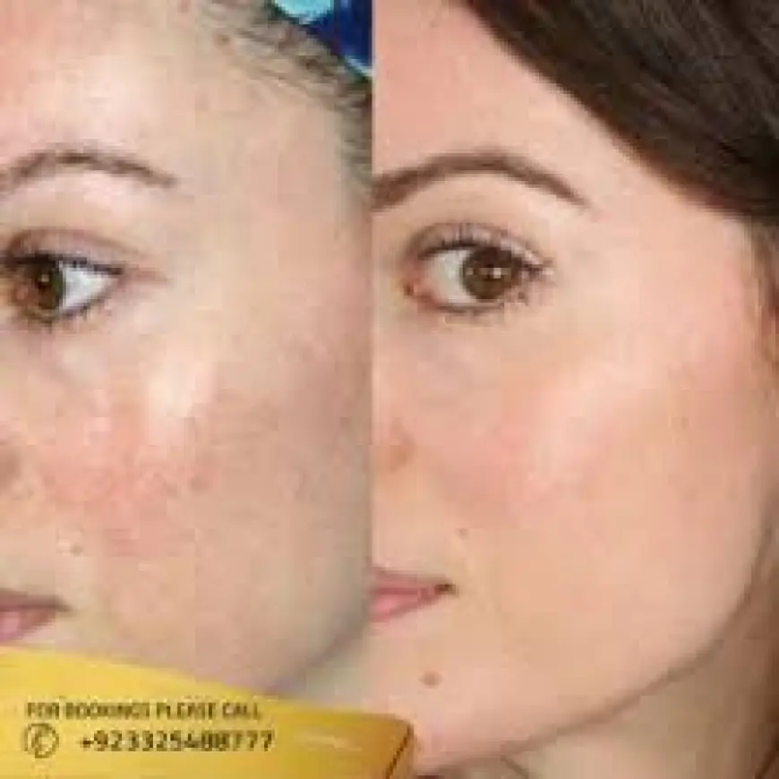 Microneedling Treatment in Islamabad – A Complete Skin Rejuvenation Guide
