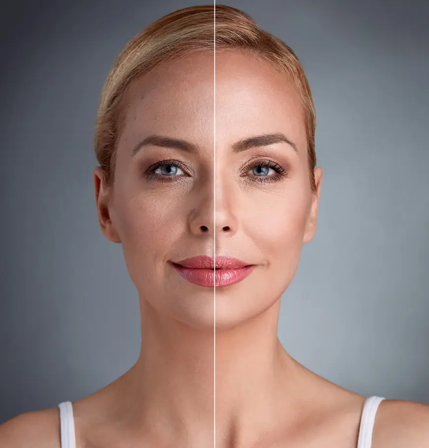 Endolift