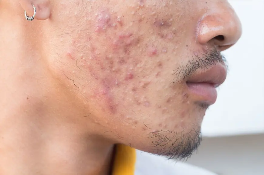 Can Pimples Treatment Improve Skin Confidence?