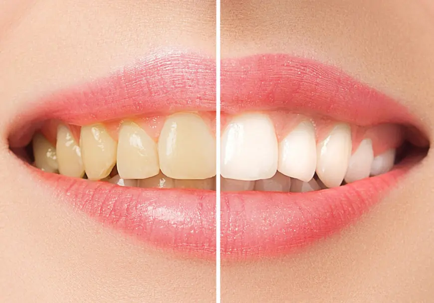 Brighten Your Smile with Professional Teeth Bleaching in Fayetteville