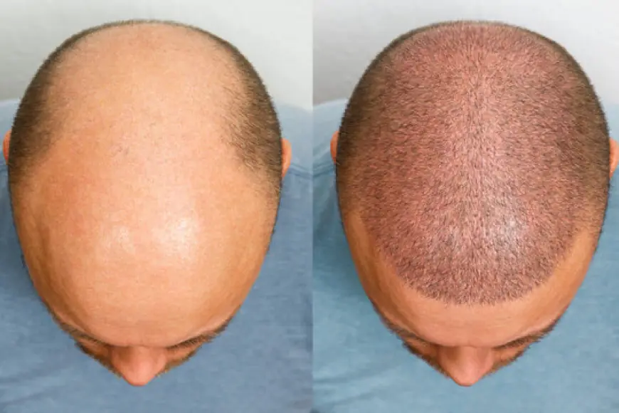 Hair Transplant Insights with Dr. Naveed