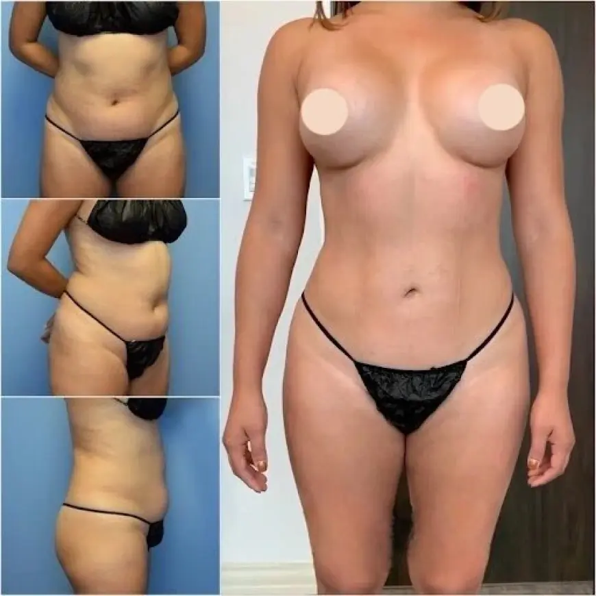 Best Doctors in Dubai for Body Contouring: Your Ultimate Guide to Perfect Results