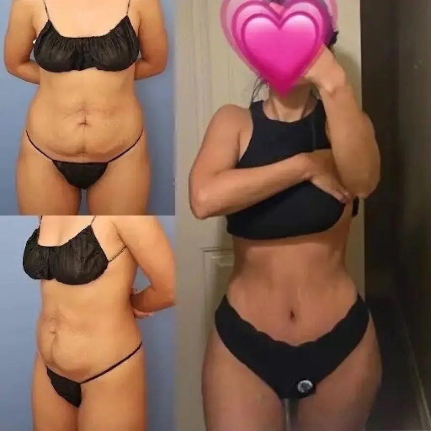 Tummy Tuck: Best Doctors in Dubai for Stunning Results