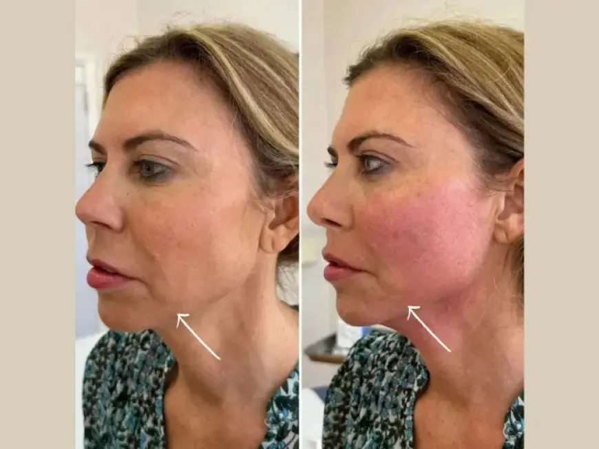 The Rise of Endolift in Dubai: Trends Noted by the Best Plastic Surgeons in dubai