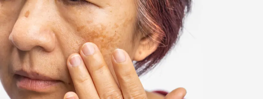 Laser Therapy for Melasma: Effective Options in Islamabad