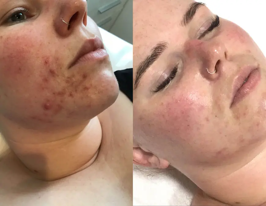 Can Acne Treatment Be Done at Home Safely?
